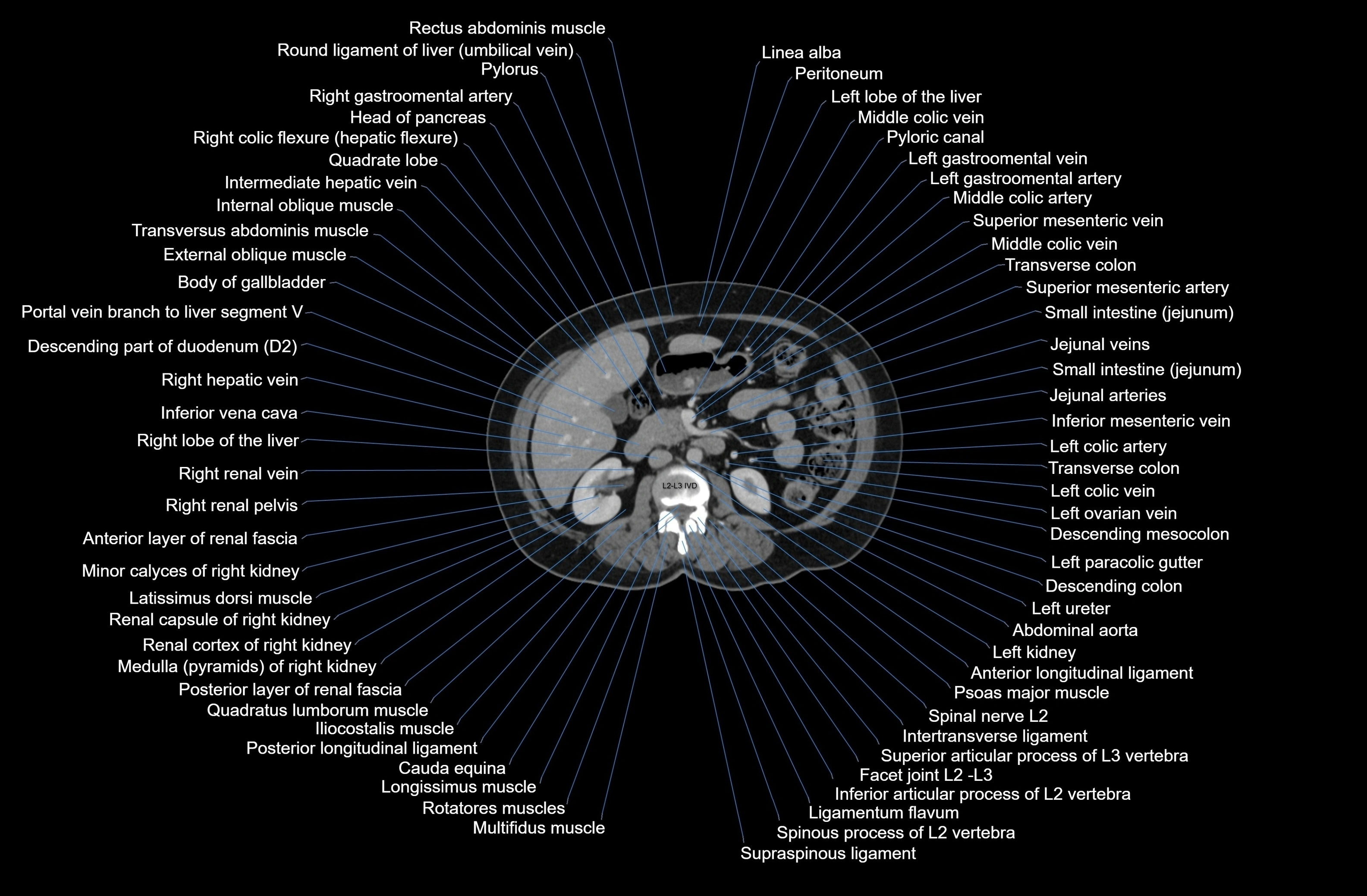 CT Abdomen axial cross sectional anatomy labelled radiology image-00039.webp